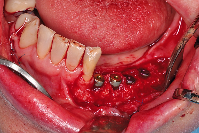 Abb. 21: Marginales Knochendefizit an den Implantatschultern 33 und 34 nach Implantatinsertion.