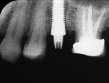 Abb. 21: Das umfangreiche Gewebeangebot des Alveolarkamms ermöglichte die optimale dreidimensionale Positionierung des einteiligen Implantates.