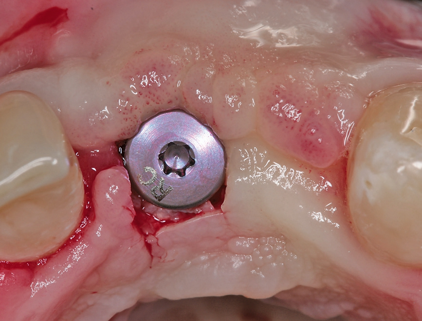 Abb. 20: Das Implantat wurde mit Rolllappenplastik freigelegt.