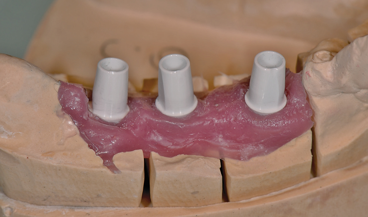 Abb. 21: Aufgeschraubte Abutments auf dem Modell.