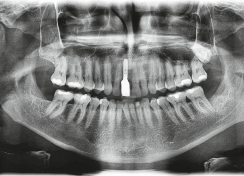 Abb. 23: Das röntgenologische Abschlussbild zeigt die knöcherne Regeneration des Defektes und die gute Osseointegration der inserierten Implantate.