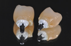Abb. 22: Zementüberschüsse an der verklebten Restauration.