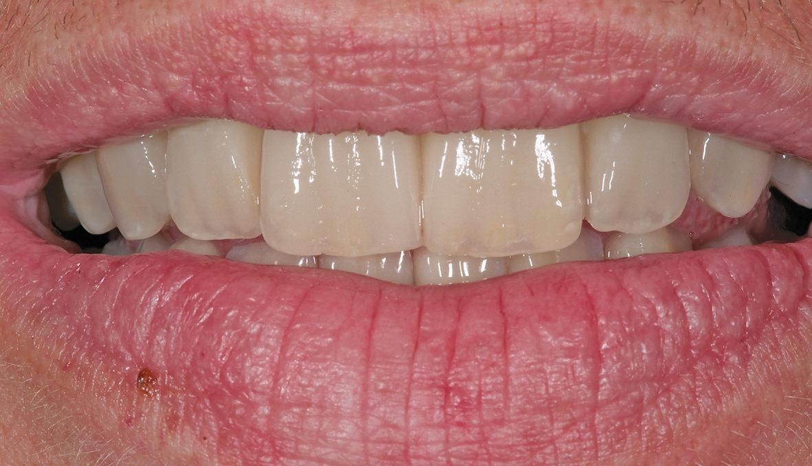 Abb. 21: Lippenbild des Patienten mit eingesetztem Zahnersatz.