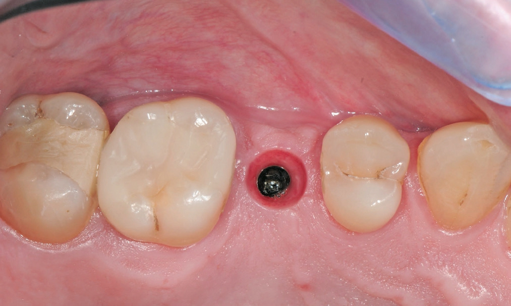 Abb. 20: Trichterförmige Emergenz als optimale Basis für die Implantatkrone.
