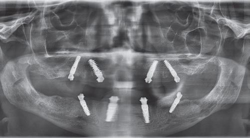 Abb. 21: OPG 5 Monate post-OP.
