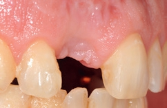 Abb. 20: Aus der lateralen Ansicht ist ein labiales Volumendefizit in der Implantatregion des Alveolarkamms zu erkennen.
