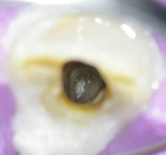 Abb. 21: Intraoperative Darstellung des inserierten apikalen Widerlagers.