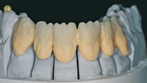 Erste Schichtung Chroma-Dentin mit HeraCeram 750 (CD B3, Kulzer).