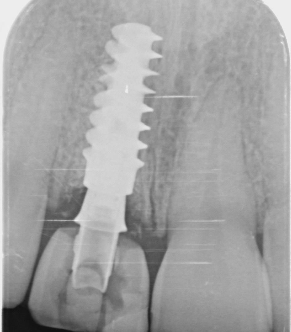 Abb. 16a: Radiologischer Zustand nach der Operation.
