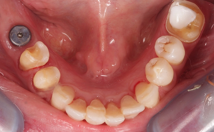 Abb. 21: Minimalinvasive Präparation der Zähne 36,33,43,44 und 45 zur Aufnahme von Teilkronen und Veneers in Presskeramik.
