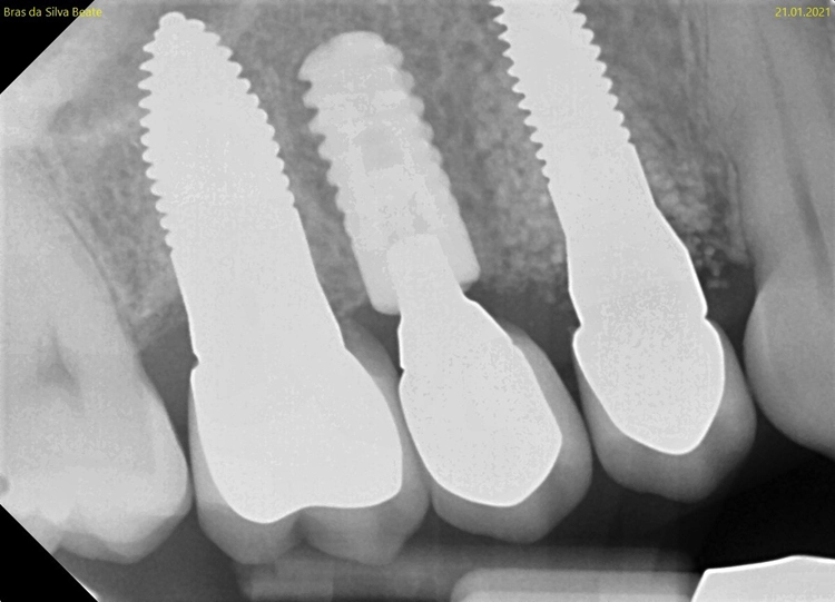 Abb. 21: Röntgenkontrolle ein Jahr und ein Monat nach Socket/Ridge Preservation.