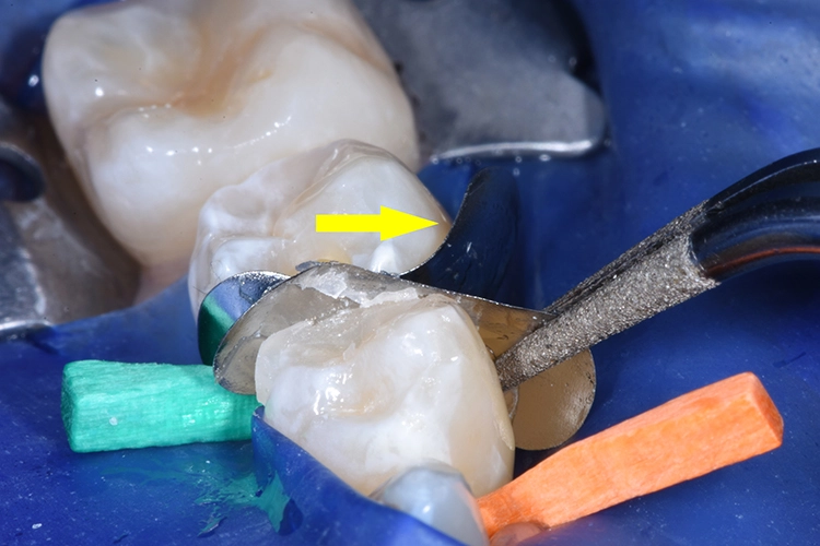 Abb. 22: Die Matrize des gefüllten Zahnes 34 wird nun etwas gelöst und seitlich aus dem Approximalraum herausgezogen. Dabei wird immer in Richtung der Spitze des Interdentalkeils gezogen (gelber Pfeil). Auf diese Weise bleibt die Matrize des benachbarten Zahnes in ihrer Position. Zum Herausziehen der Matrize reicht in der Regel eine Pinzette, ansonsten kann die Matrize auch mit einer Zange gefasst werden.