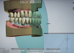 Abb. 21: Anpassung von Overjet und Overbite.