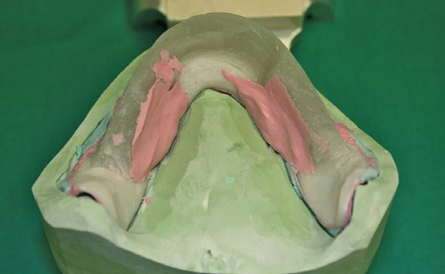 Abb. 17: Die Abformung des Zungenraums ist ein wichtiger Schritt für den Erhalt der gewohnten Phonetik und das Tragegefühl der Totalprothese.