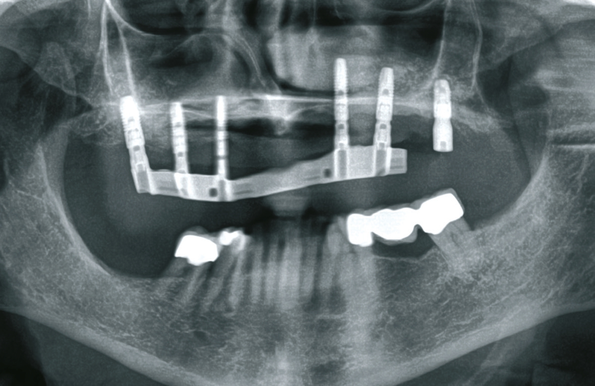 Abb. 20: Gekürzter Steg mit neuem Implantat regio 27.