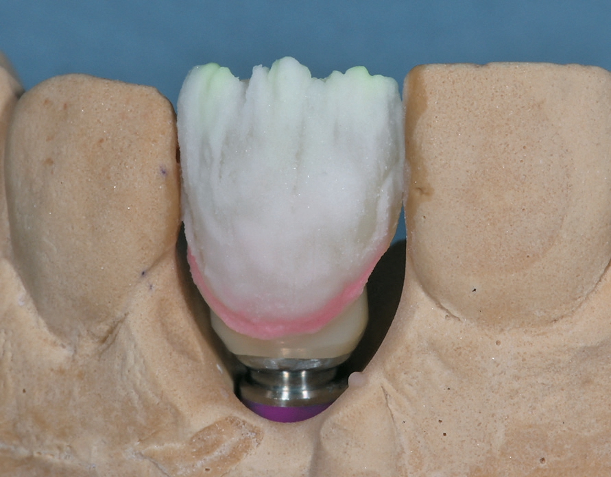 Abb. 20: Der Vorbereitungsbrand mit Opakdentin-, Dentin- und Schultermassen. Die Keramik wird sehr dünn aufgetragen und 30 °C über der Temperatur des Dentinbrandes gebrannt, um einen guten Verbund der Keramik zum Käppchen zu schaffen.