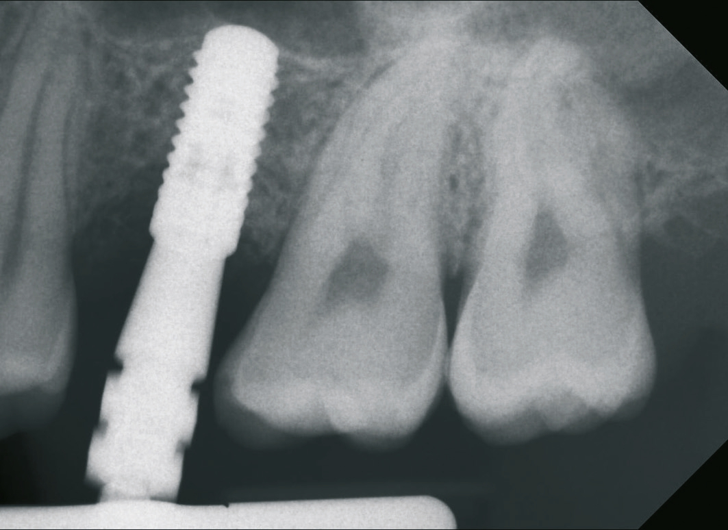 Abb. 22: Radiologische Kontrolle des eingesetzten Abformpfostens auf Passgenauigkeit.