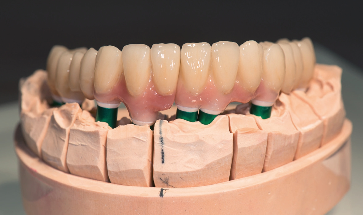 Abb. 22: Die fertiggestellten Brücken auf dem Modell ohne Zahnfleischmaske von labial.
