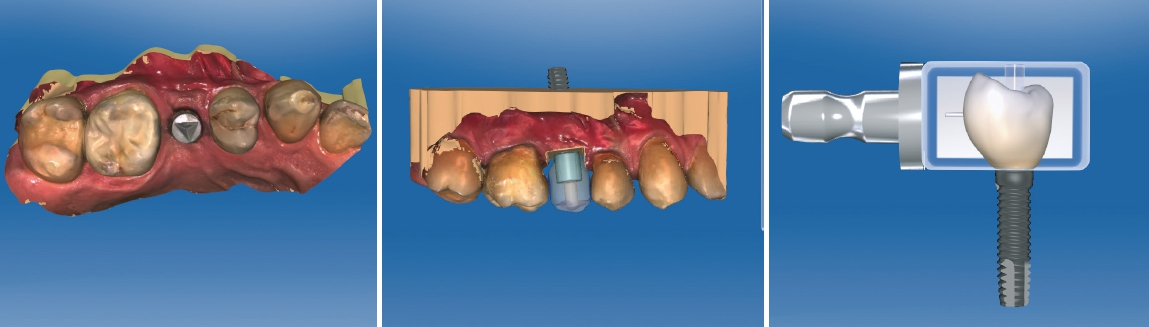 Abb. 21a bis c: Digitale Konstruktion der Implantatkrone nach intraoraler Datenerfassung des Implantats mit Scanbody SICvantage.