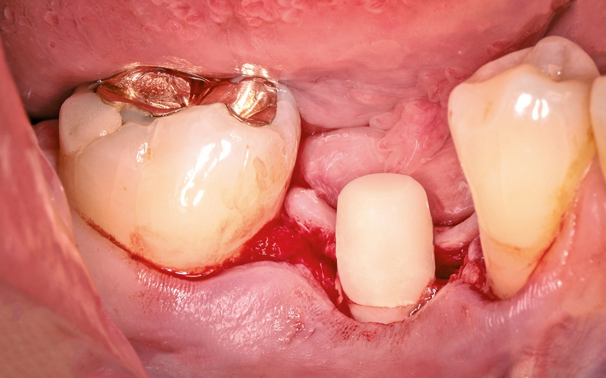 Abb. 22: Das ceramic.implant wurde mit dem temp.cap versorgt.
