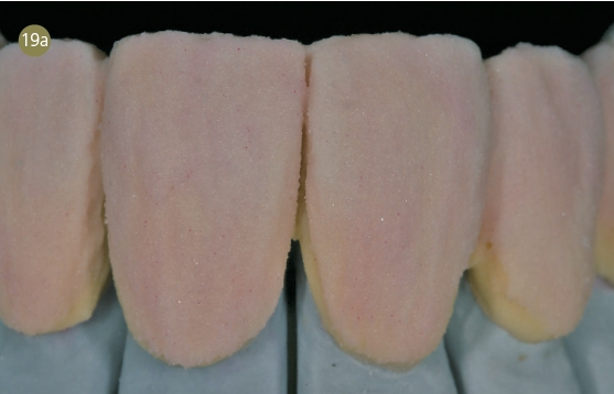 Aufbauen der groben Form mit Dentinmasse.