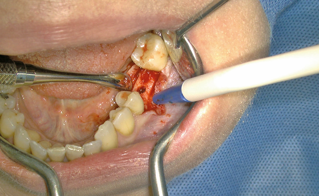 Abb. 28: Blick auf das vorbereitete Implantatbett.