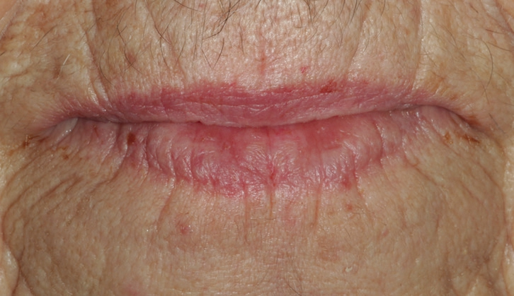 Abb. 29: Mit der eingegliederten Neuversorgung ist das Lippenbild harmonisch (vgl. mit der Altversorgung in Abb. 2).
