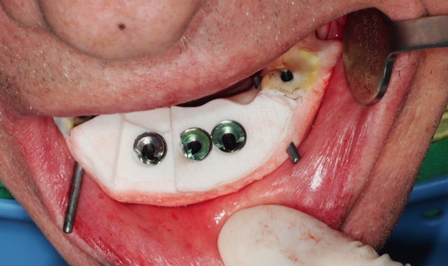Abb. 23: Insert für die vollnavigierte Implantologie der intraforaminalen Implantate, versplintet mit der Basisschablone.