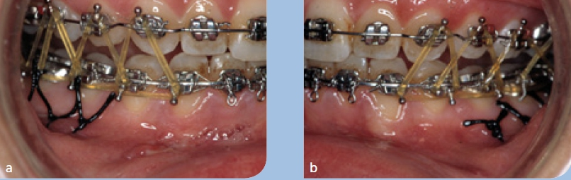 Abb. 21 a u. b: Zur Schließung des offenen Bisses und zur Stabilisierung des Ergebnisses werden Up-and-down-Elastics 3–4 Tage nach der Operation eingehängt.