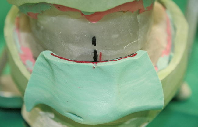 Abb. 18: Markierung der inneren und äußeren Mitte.