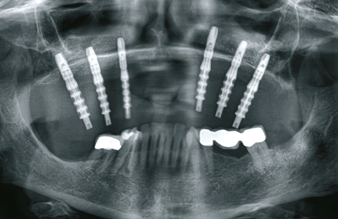 Abb. 21: Vorbereitungen für die Einbeziehung des neuen Implantats in die Stegversorgung.