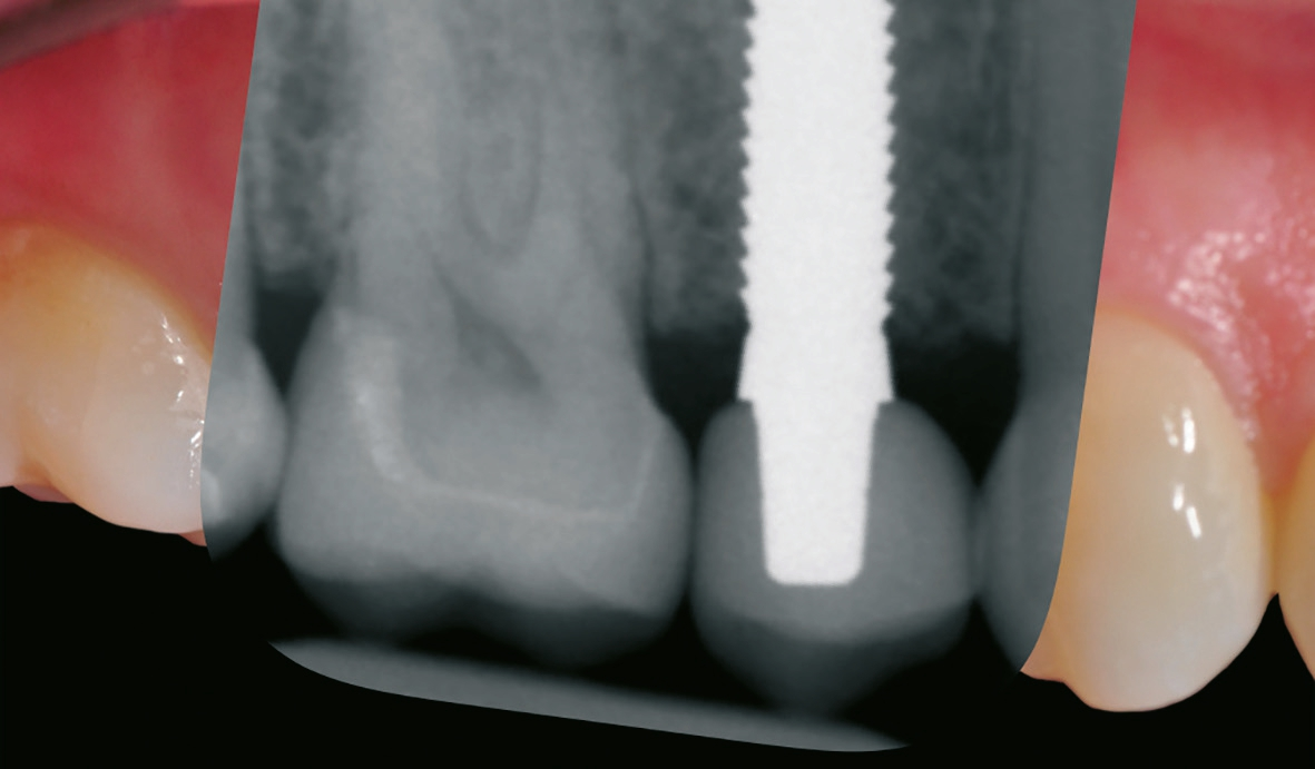 Abb. 23: Das überlagerte Röntgenbild zeigt den optimalen prothetischen Einschub des Implantats.