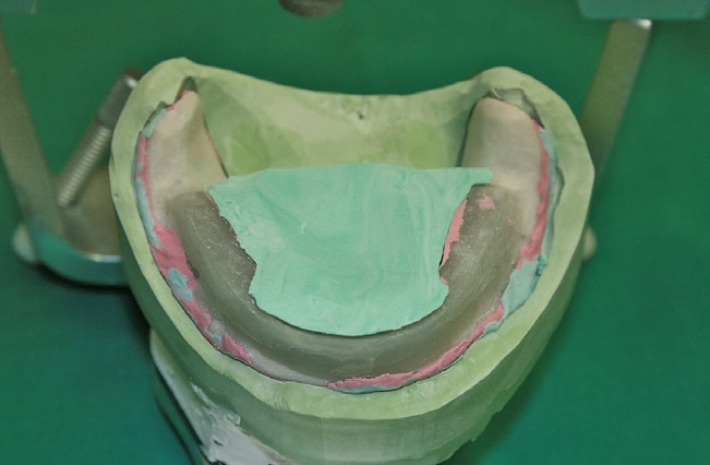 Abb. 19: Einlegen der Silikonzunge.