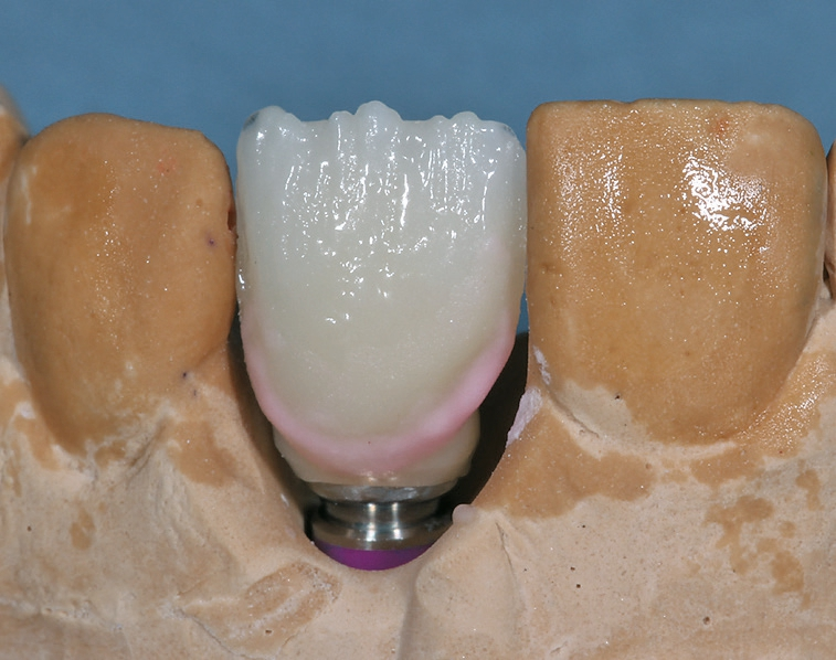 Abb. 22: Im zervikalen Bereich wird Gingivamasse, gemischt mit Dentin, angelegt