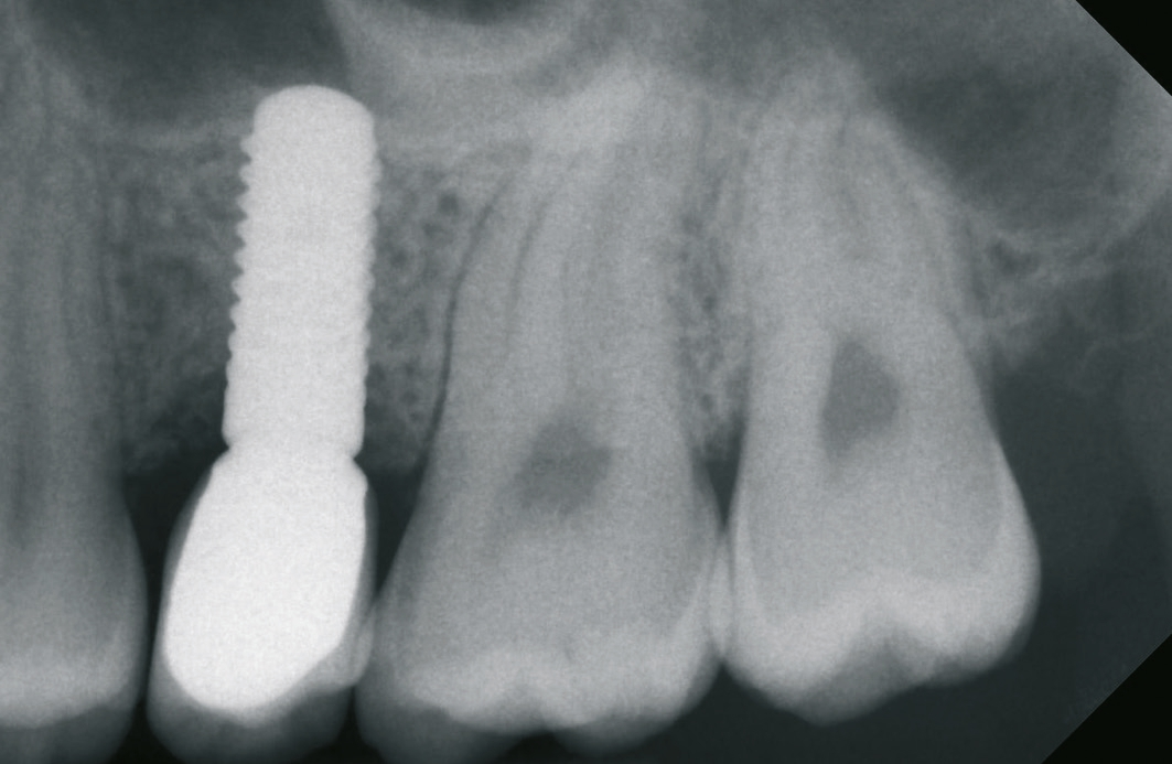 Abb. 24: Acht Monate nach Versorgung des Implantats weiterhin stabile ossäre Verhältnisse.