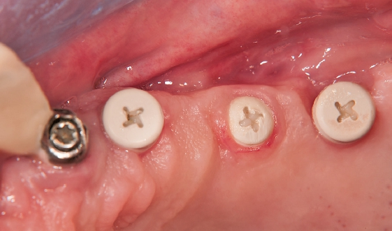 Abb. 24: Nach drei Wochen verheilte Gingiva.