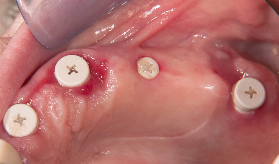 Abb. 24: Zwei Wochen nach Freilegen mit Gingivaformern.