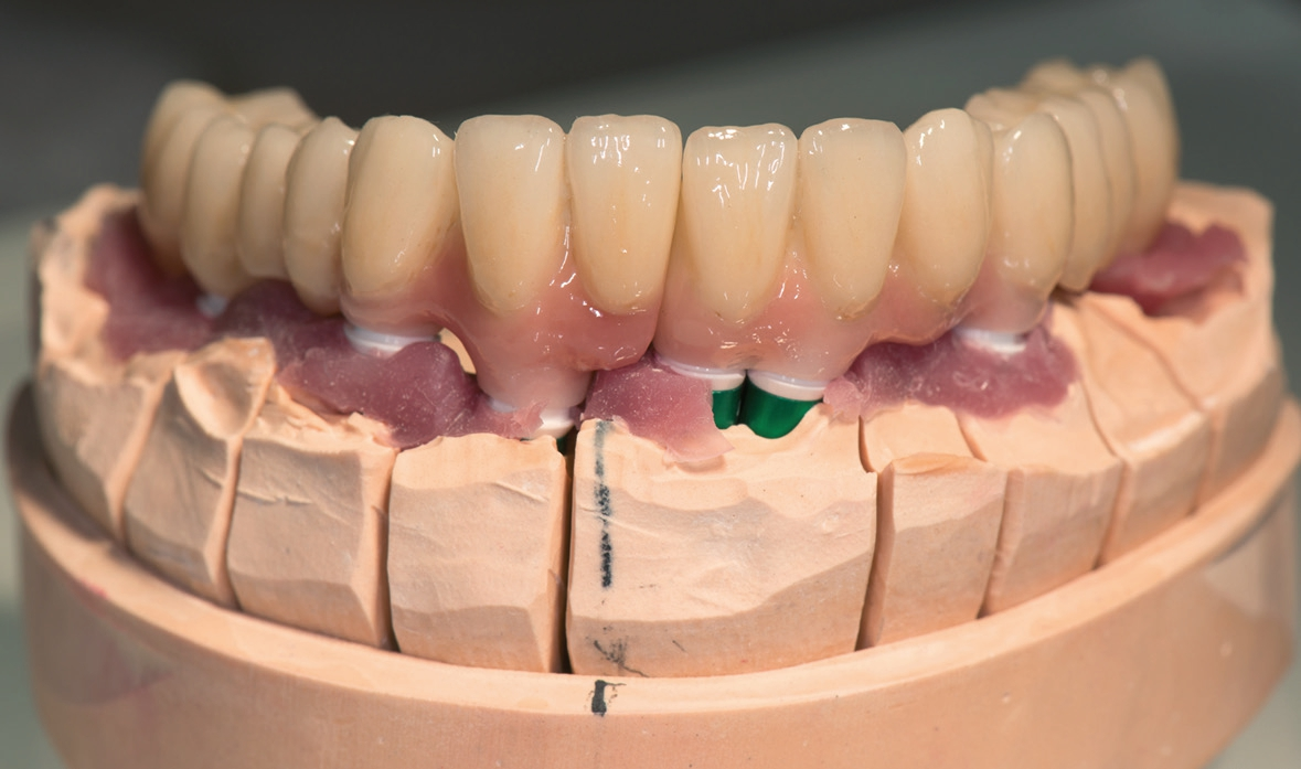 Abb. 24: Die fertiggestellten Brücken auf dem Modell mit Zahnfleischmaske von labial.