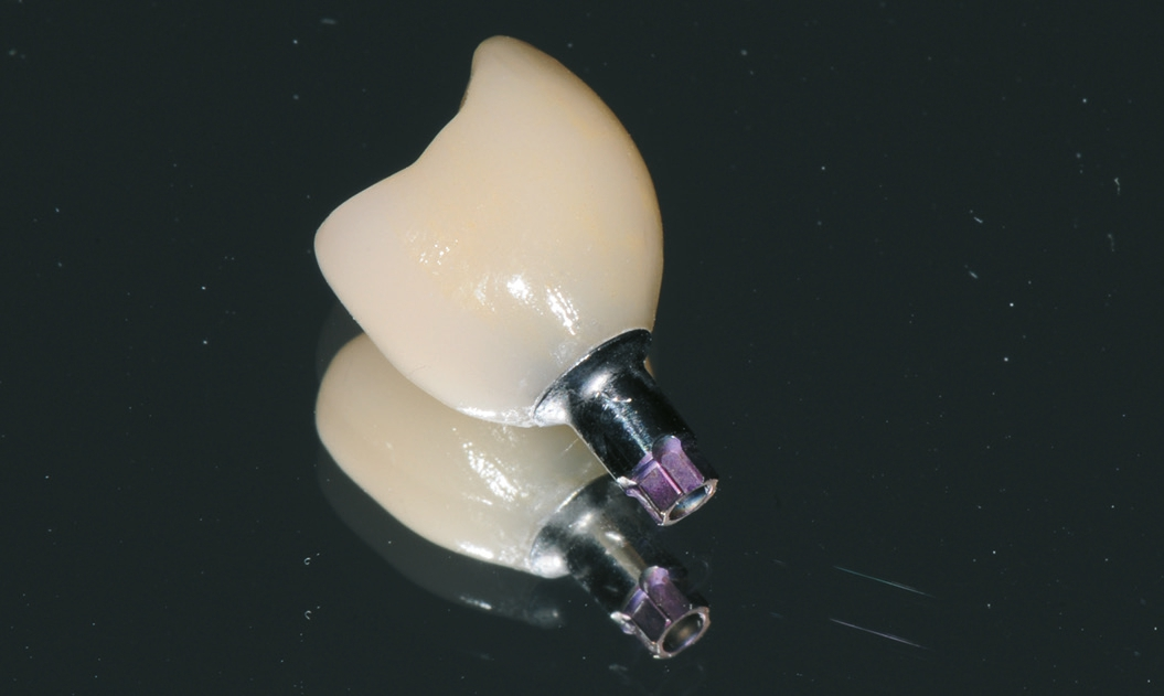 Abb. 23: Implantatkrone zum Einsetzen vorbereitet.