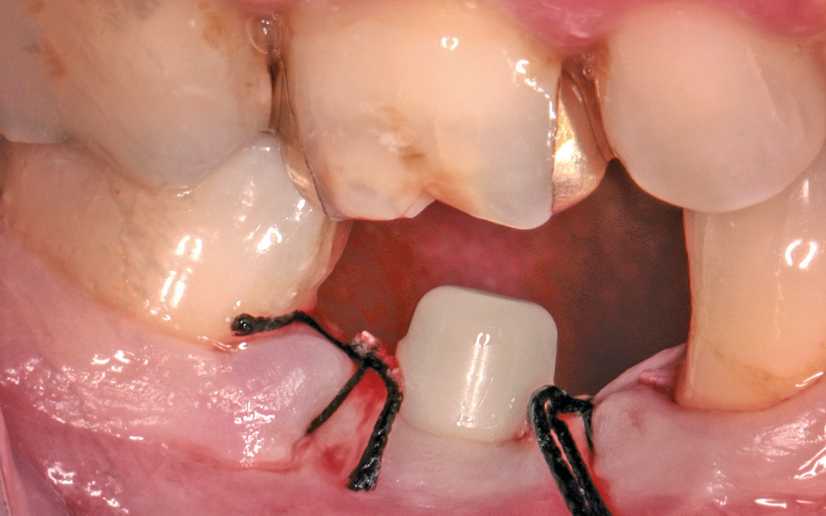 Abb. 24: Die Schleimhaut wurde um den Implantatkopf adaptiert.