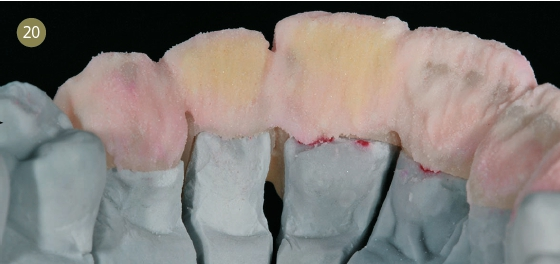 Neues Auftragen von Chroma-Dentin.
