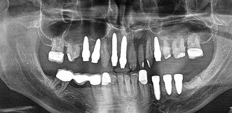 Abb. 24: Röntgen zwei Monate nach Implantation.