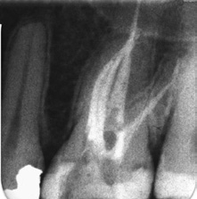 Abb. 14a–d: Unterschiedliche Konfigurationen oberer Molaren mit einem mb2.