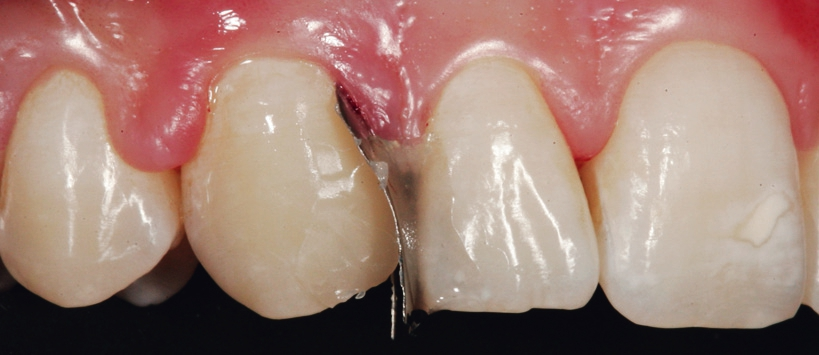 Abb. 24: Der aufgebrachte Dentinkern.