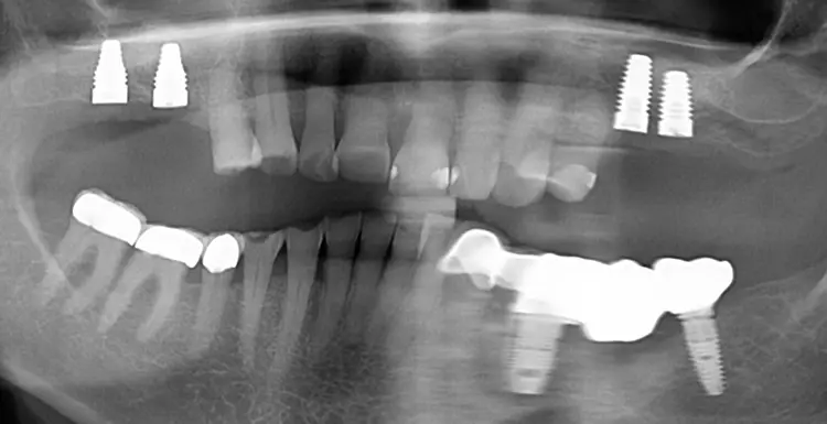 Abb. 24: Röntgenkontrolle post-OP.