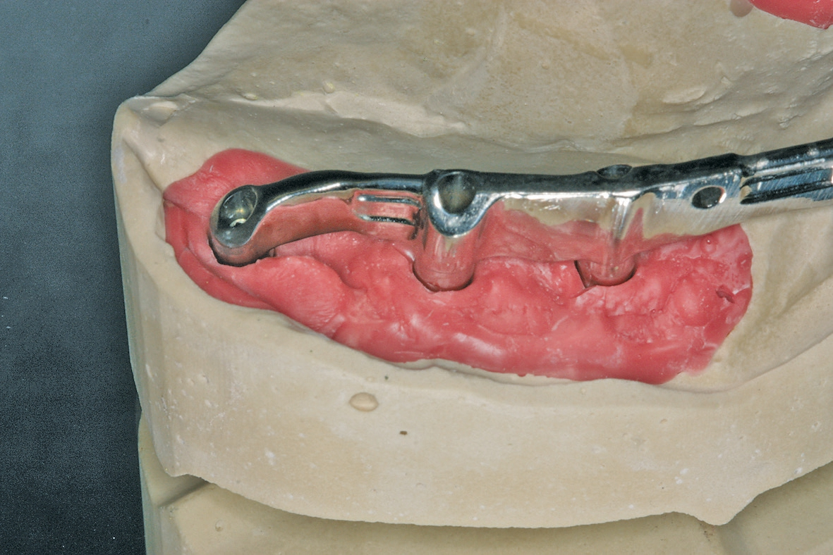 Abb. 22b: Der Zahntechniker hatte eine schwierige Herausforderung zu meistern. Das ergänzte Stegstück musste sowohl zur neuen Position des Implantats bzw. Abutments als auch zum bereits gefertigten Stegbogen passen, selbstverständlich spannungsfrei.