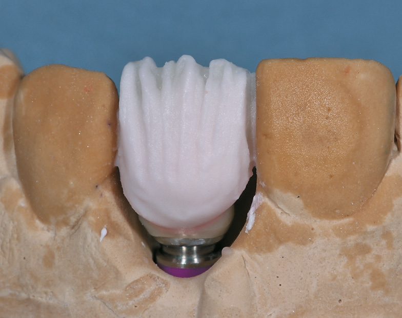 Abb. 23: Auftrag der verkleinerten Zahnform in Dentinmassen.