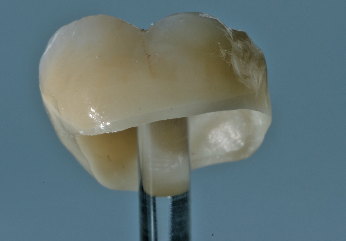 Abb. 25: Beispiel der Hochglanzpolitur des zervikalen Randes einer Zirkoniumdioxidkrone für den Kontakt zum Weichgewebe.