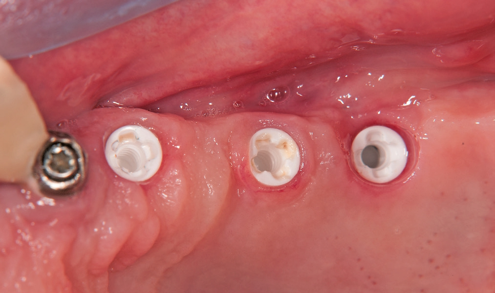Abb. 25: Ansicht der neuen Implantat-Anschlussgeometrie.