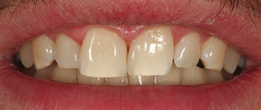 Abb. 29: Lippenbild der fertiggestellten Restaurationen.